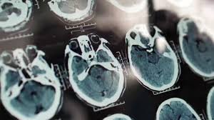 Nguy cơ mắc chứng mất trí tuệ có thể cao gấp đôi khi người Mỹ tuổi thọ cao