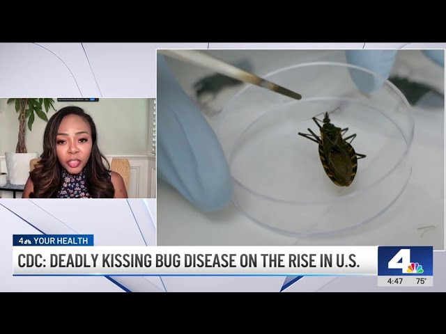 BỆNH MỚI CHẾT NGƯỜI Ở MỸ “KISSING BUG” (BỌ HÔN)!